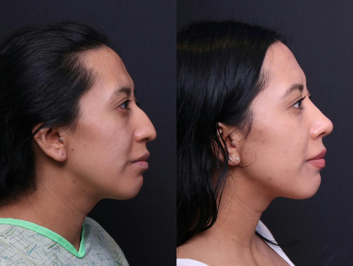 Rhinoplasty Before & After Gallery - Patient 372630 - Image 3