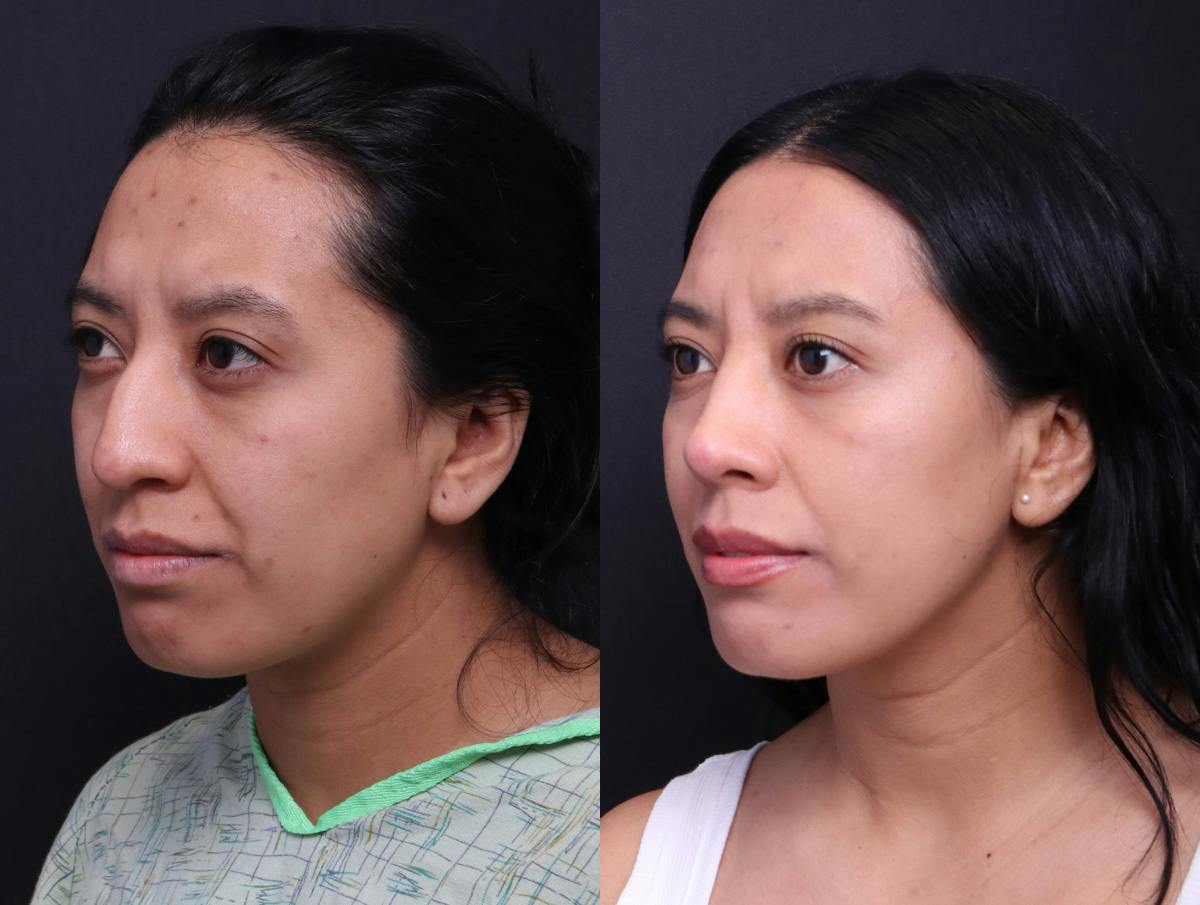Rhinoplasty Before & After Gallery - Patient 372630 - Image 4