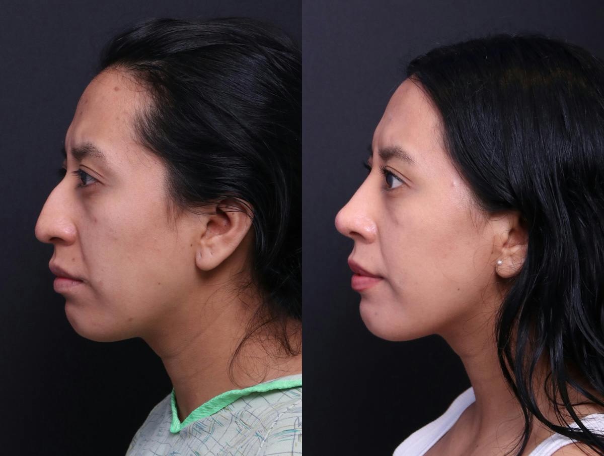Rhinoplasty Before & After Gallery - Patient 372630 - Image 5