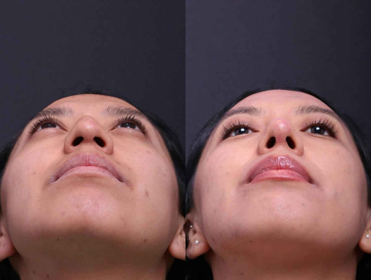 Rhinoplasty Before & After Gallery - Patient 372630 - Image 6