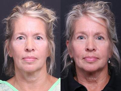 Blepharoplasty Before & After Gallery - Patient 268693 - Image 1