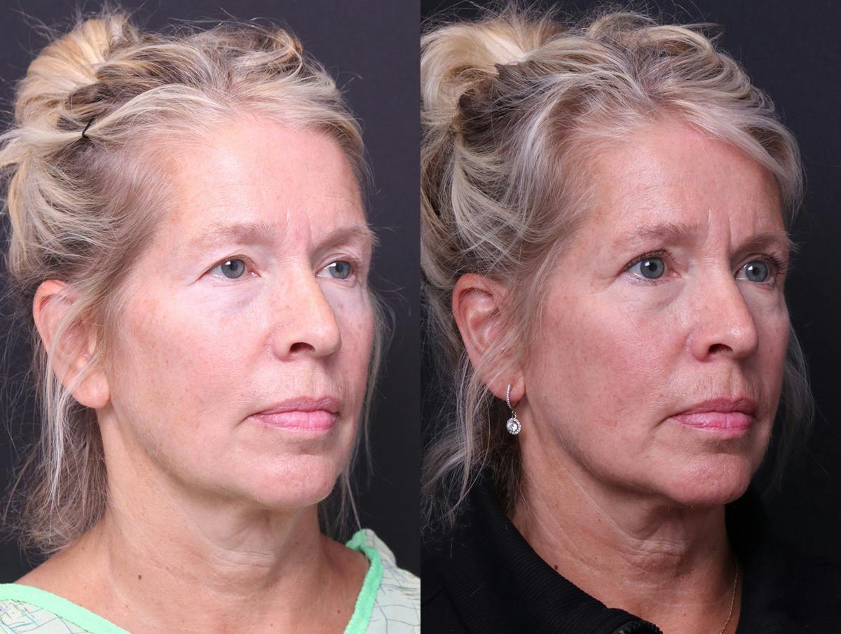 Blepharoplasty Before & After Gallery - Patient 268693 - Image 2