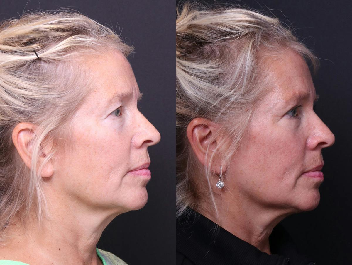 Blepharoplasty Before & After Gallery - Patient 268693 - Image 3