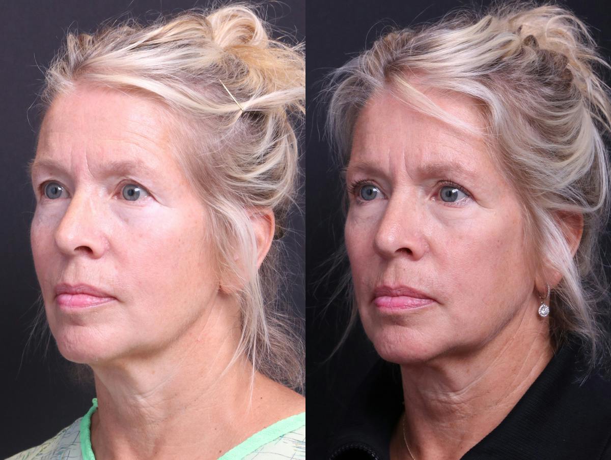 Blepharoplasty Before & After Gallery - Patient 268693 - Image 4