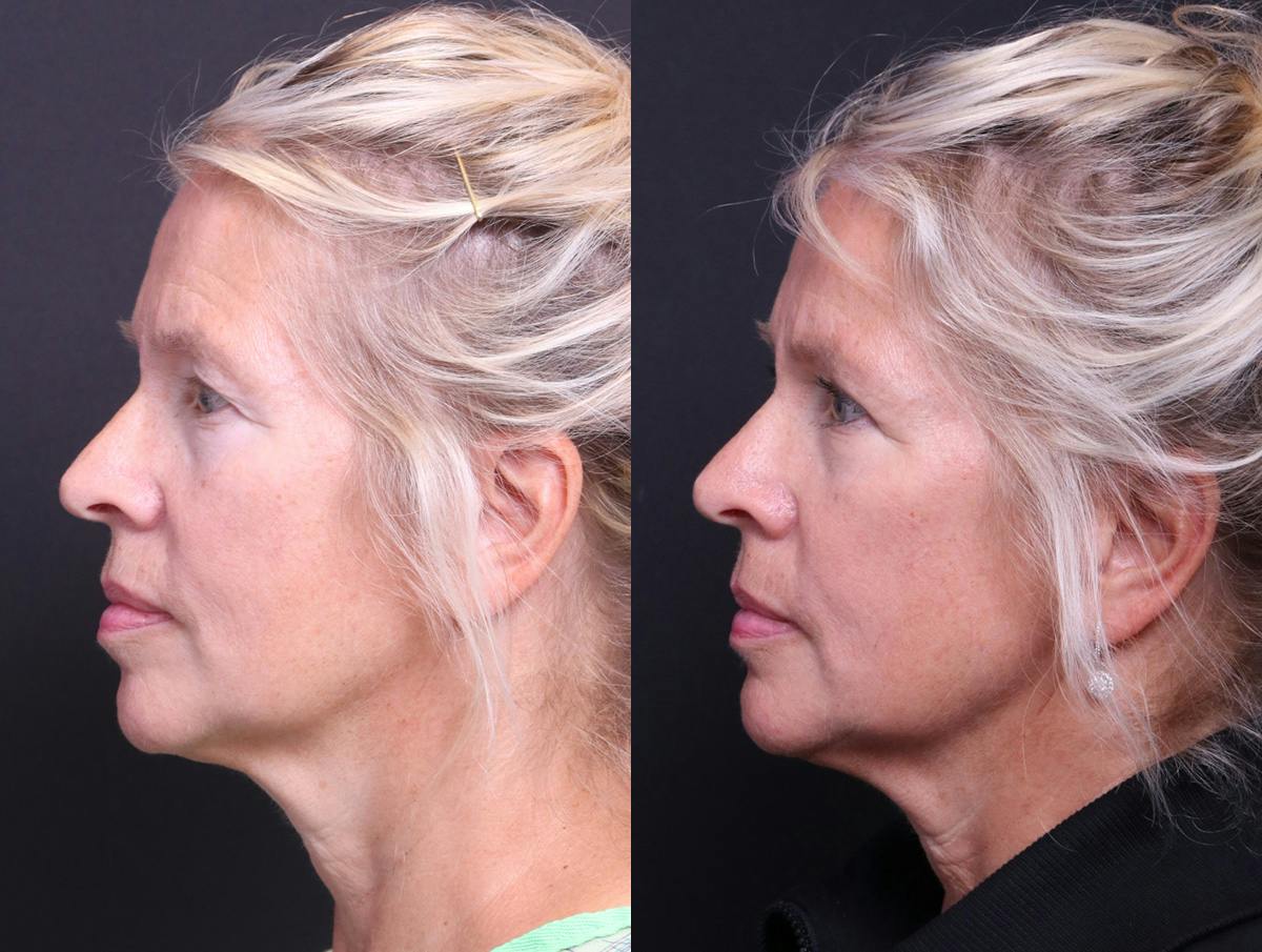 Blepharoplasty Before & After Gallery - Patient 268693 - Image 5