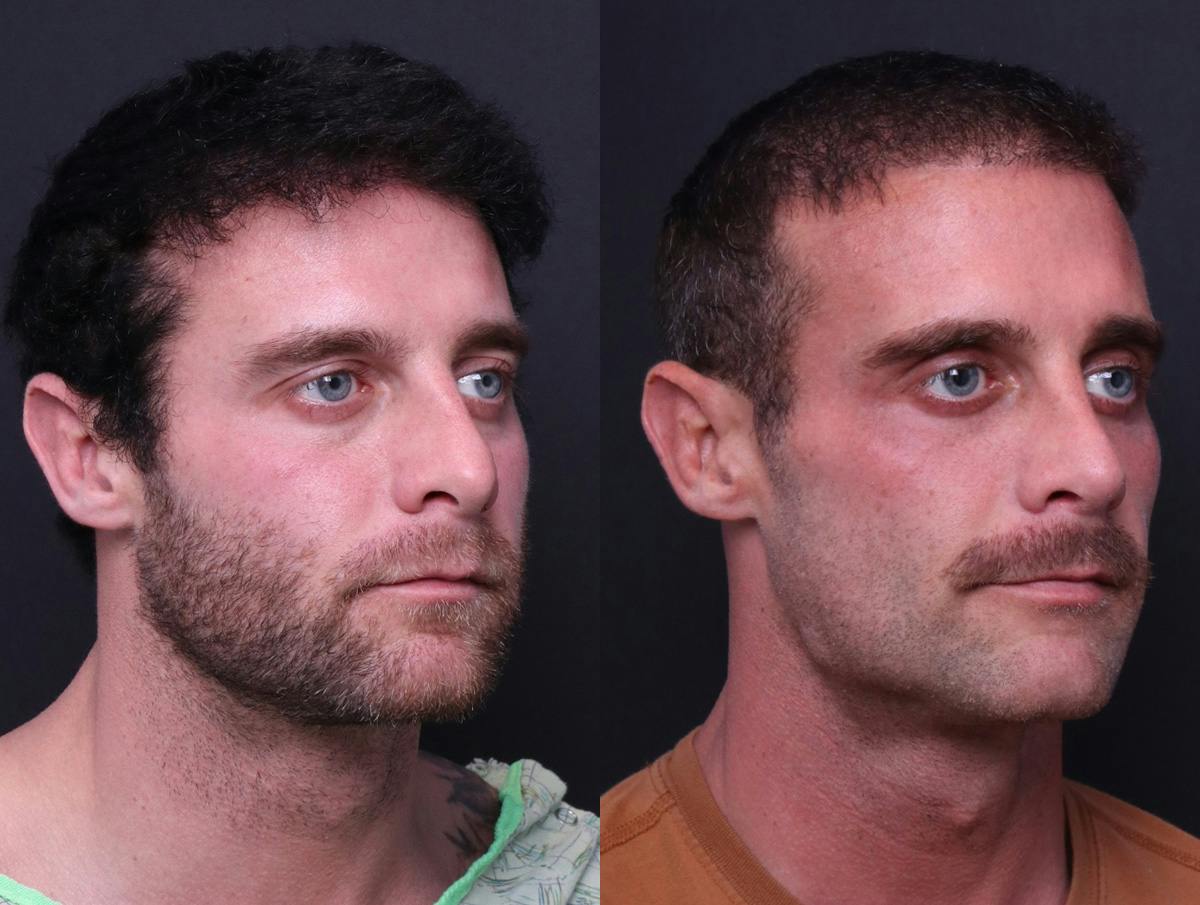 Rhinoplasty Before & After Gallery - Patient 198487 - Image 2
