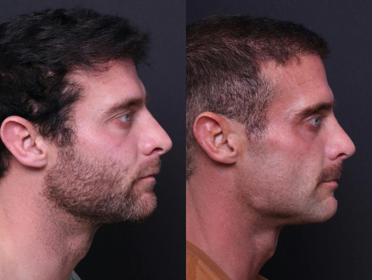 Rhinoplasty Before & After Gallery - Patient 198487 - Image 3