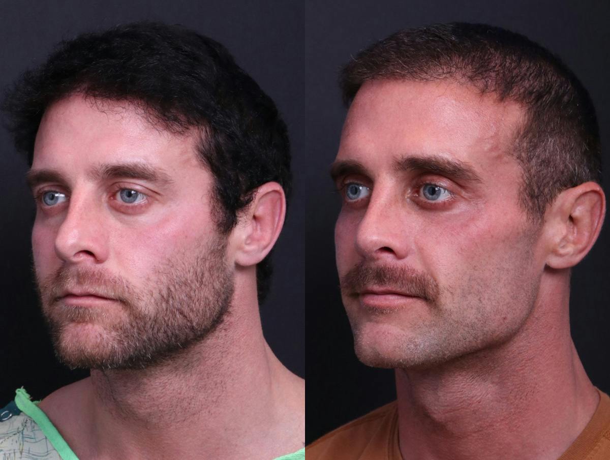 Rhinoplasty Before & After Gallery - Patient 198487 - Image 4