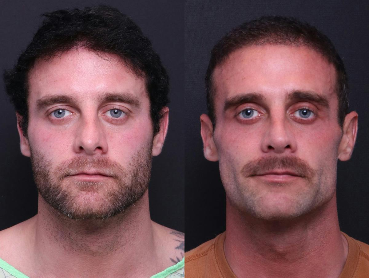 Rhinoplasty Before & After Gallery - Patient 198487 - Image 1