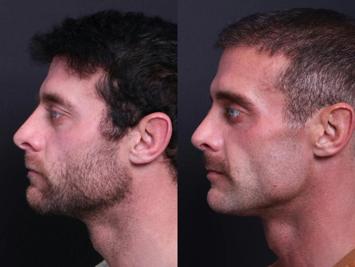 Rhinoplasty Before & After Gallery - Patient 198487 - Image 5