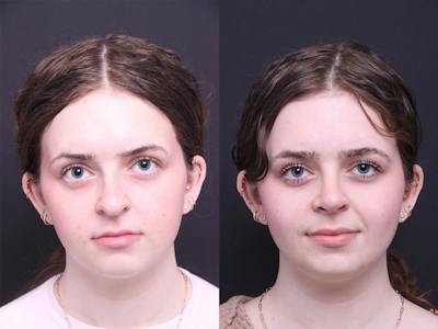 Rhinoplasty Before & After Gallery - Patient 264903 - Image 1