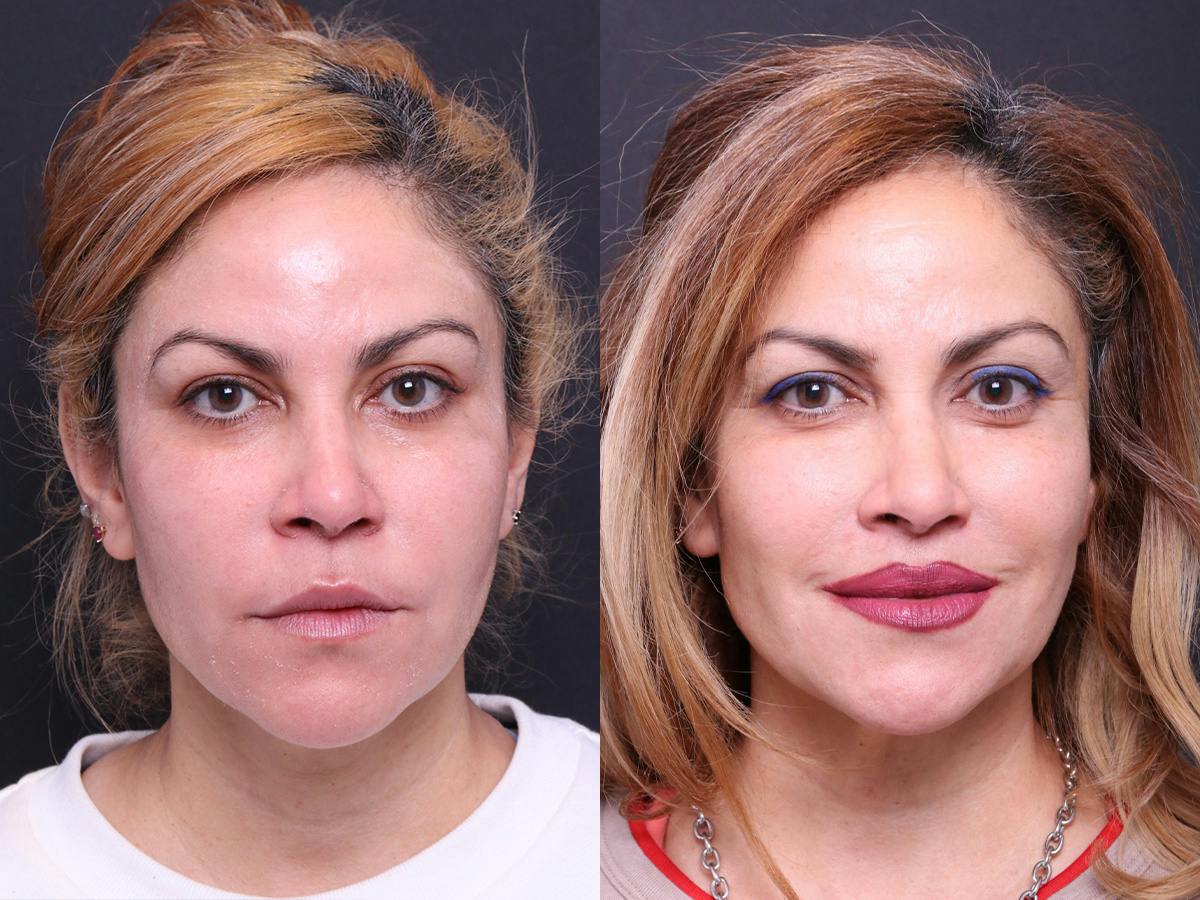Lip Lift Before & After Gallery - Patient 695885 - Image 1