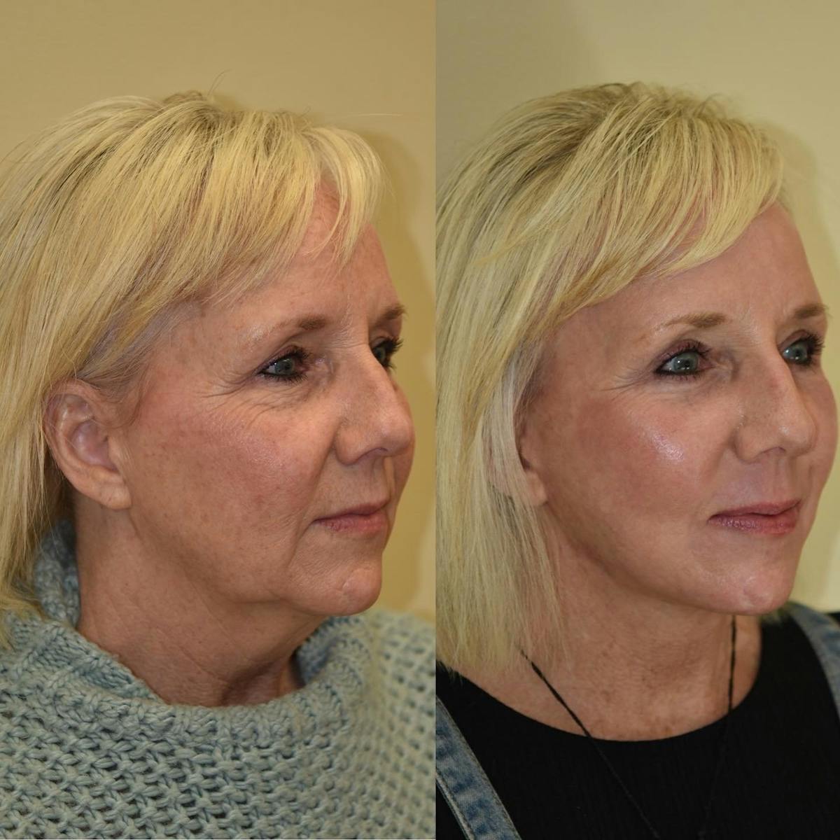 Brow Lift Before & After Gallery - Patient 594436 - Image 1