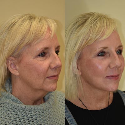 Neck Lift Before & After Gallery - Patient 143147 - Image 1