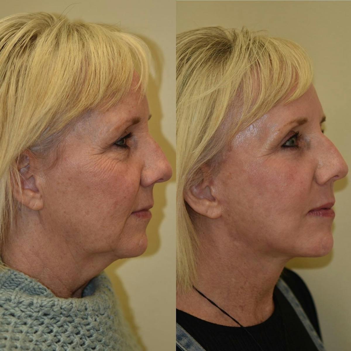 Brow Lift Before & After Gallery - Patient 594436 - Image 3