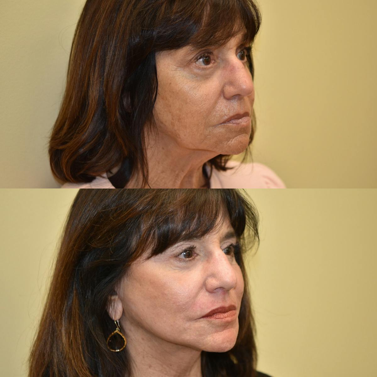 Face Liposuction Before & After Gallery - Patient 225776 - Image 1