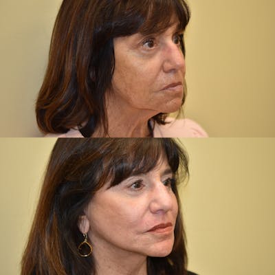 Neck Lift Before & After Gallery - Patient 420598 - Image 1