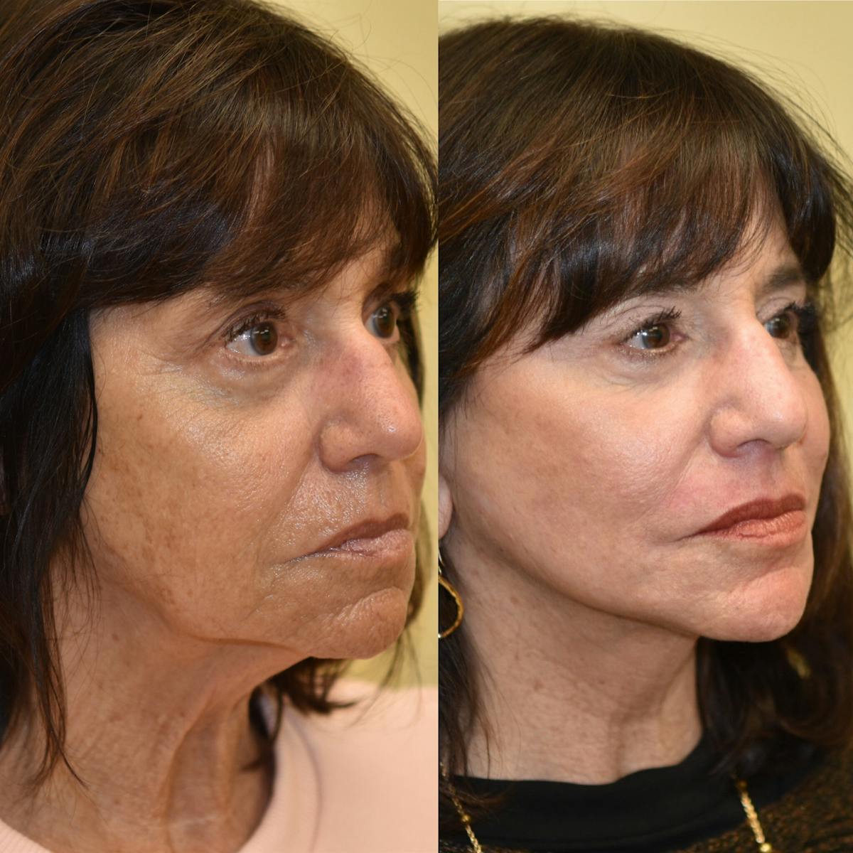 Face Liposuction Before & After Gallery - Patient 225776 - Image 2