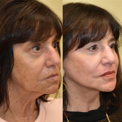 Neck Lift Before & After Gallery - Patient 420598 - Image 1