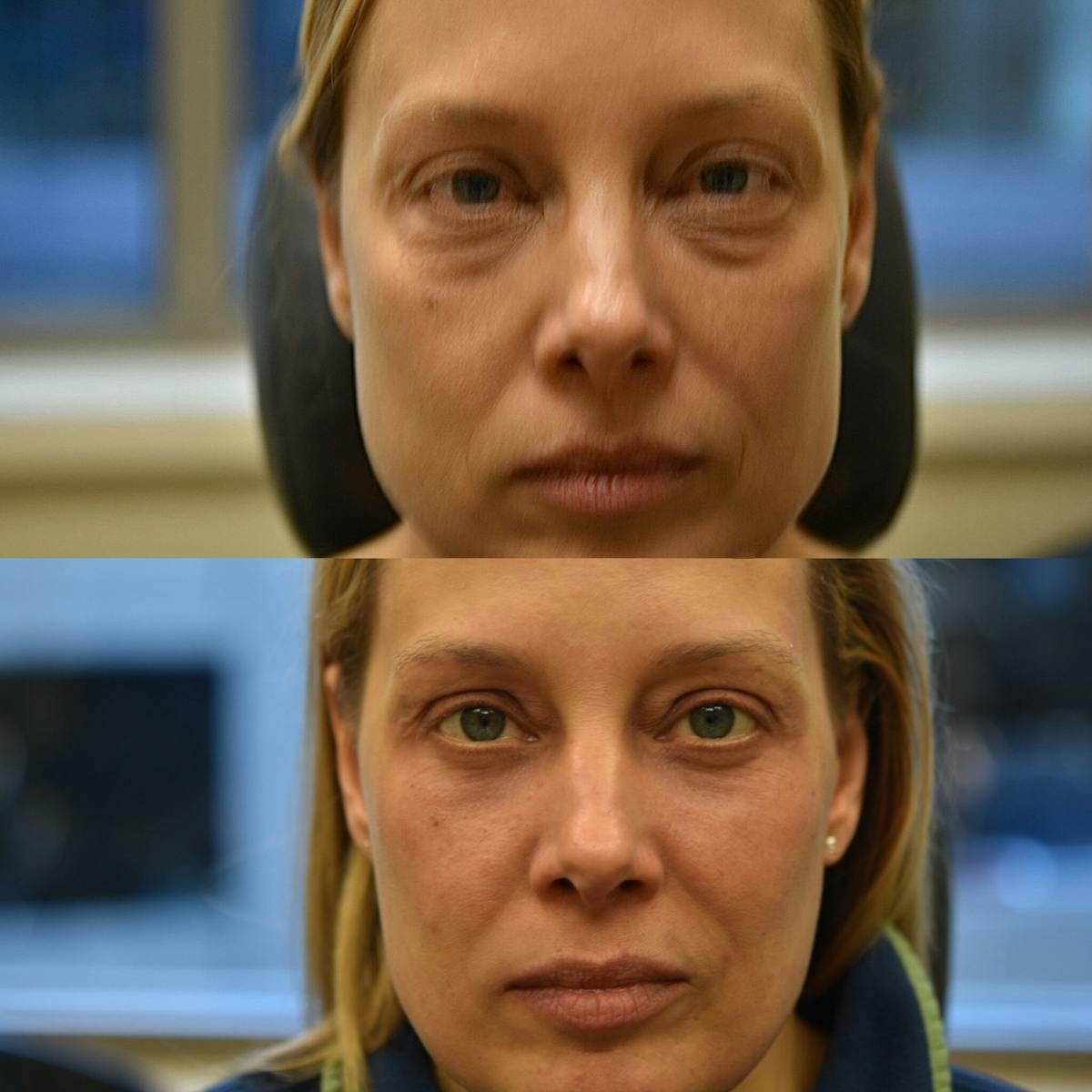 Eyelid Surgery Before & After Gallery - Patient 196261 - Image 1