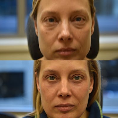 Eyelid Surgery Before & After Gallery - Patient 196261 - Image 1