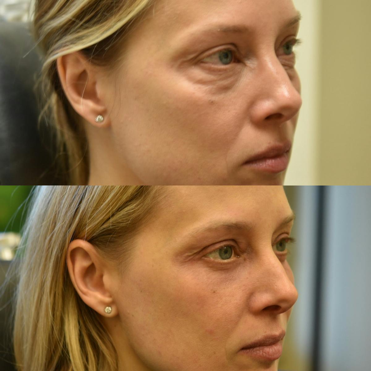 Eyelid Surgery Before & After Gallery - Patient 196261 - Image 2