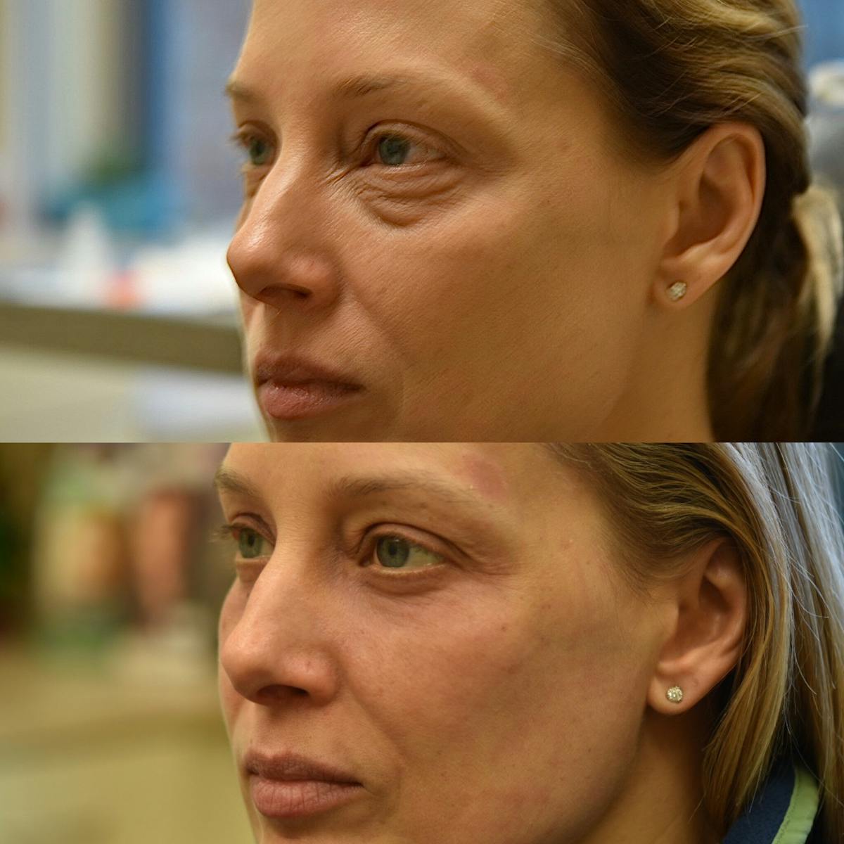 Eyelid Surgery Before & After Gallery - Patient 196261 - Image 3