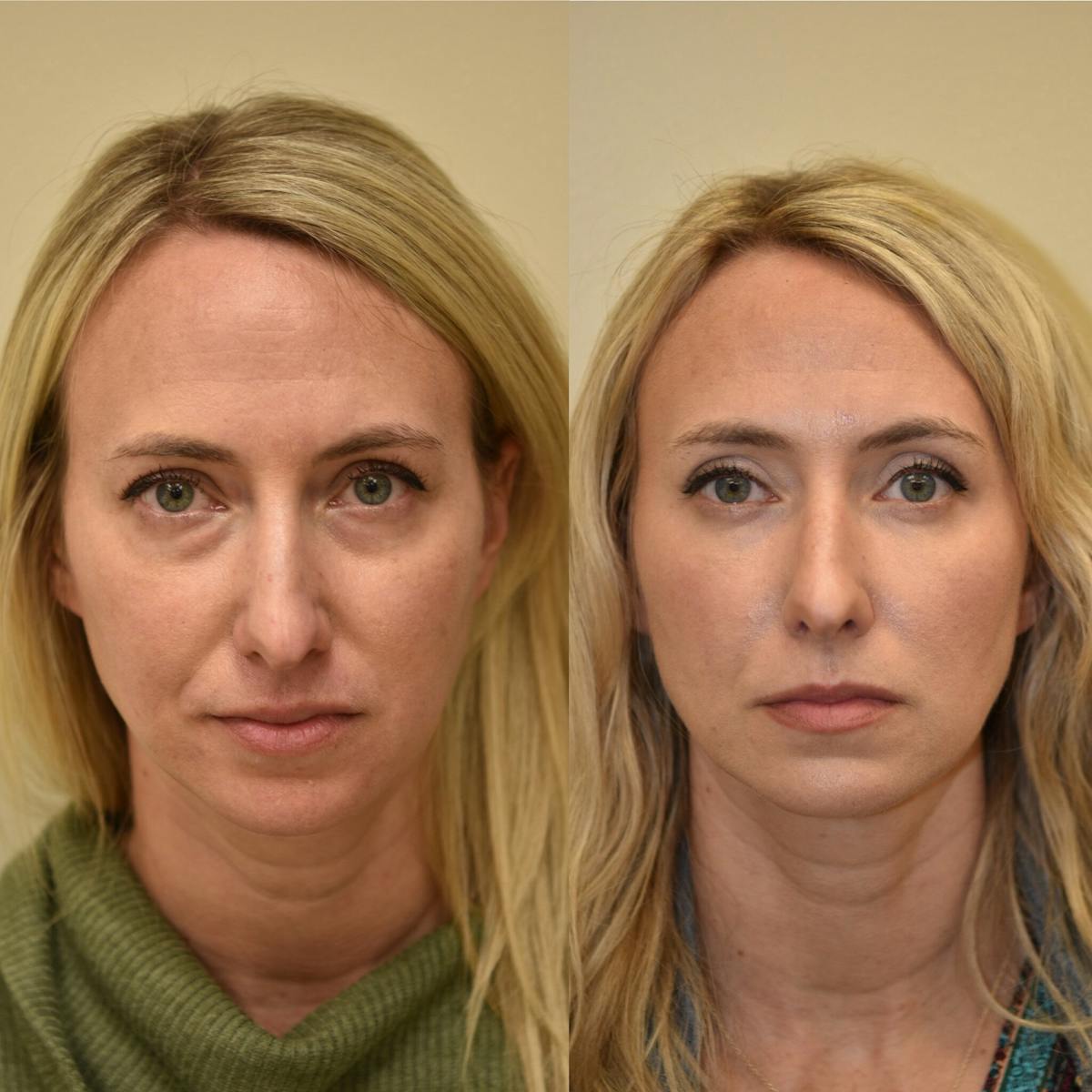 Eyelid Surgery Before & After Gallery - Patient 226116 - Image 1