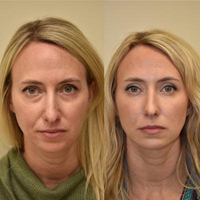 Fat Transfer Before & After Gallery - Patient 394658 - Image 1