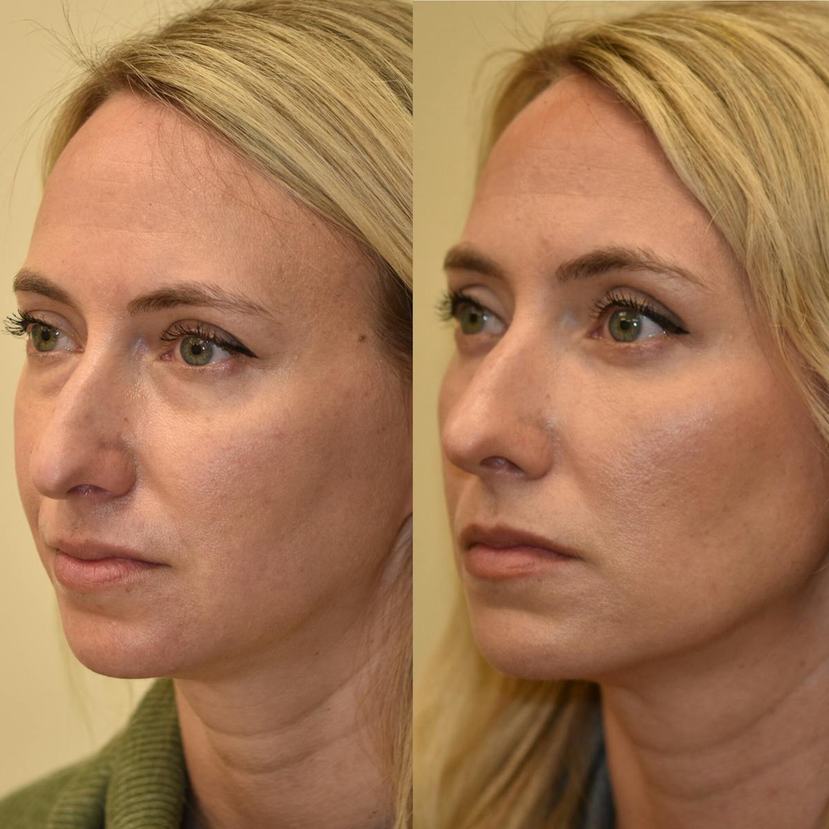 Eyelid Surgery Before & After Gallery - Patient 226116 - Image 2