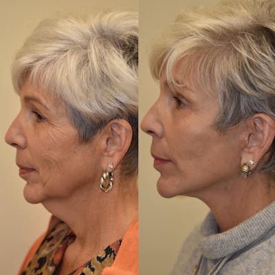 Neck Lift Before & After Gallery - Patient 339918 - Image 1