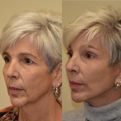 Neck Lift Before & After Gallery - Patient 339918 - Image 1