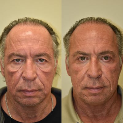 Eyelid Surgery Before & After Gallery - Patient 193897 - Image 1