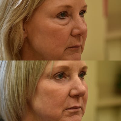 Eyelid Surgery Before & After Gallery - Patient 327140 - Image 1