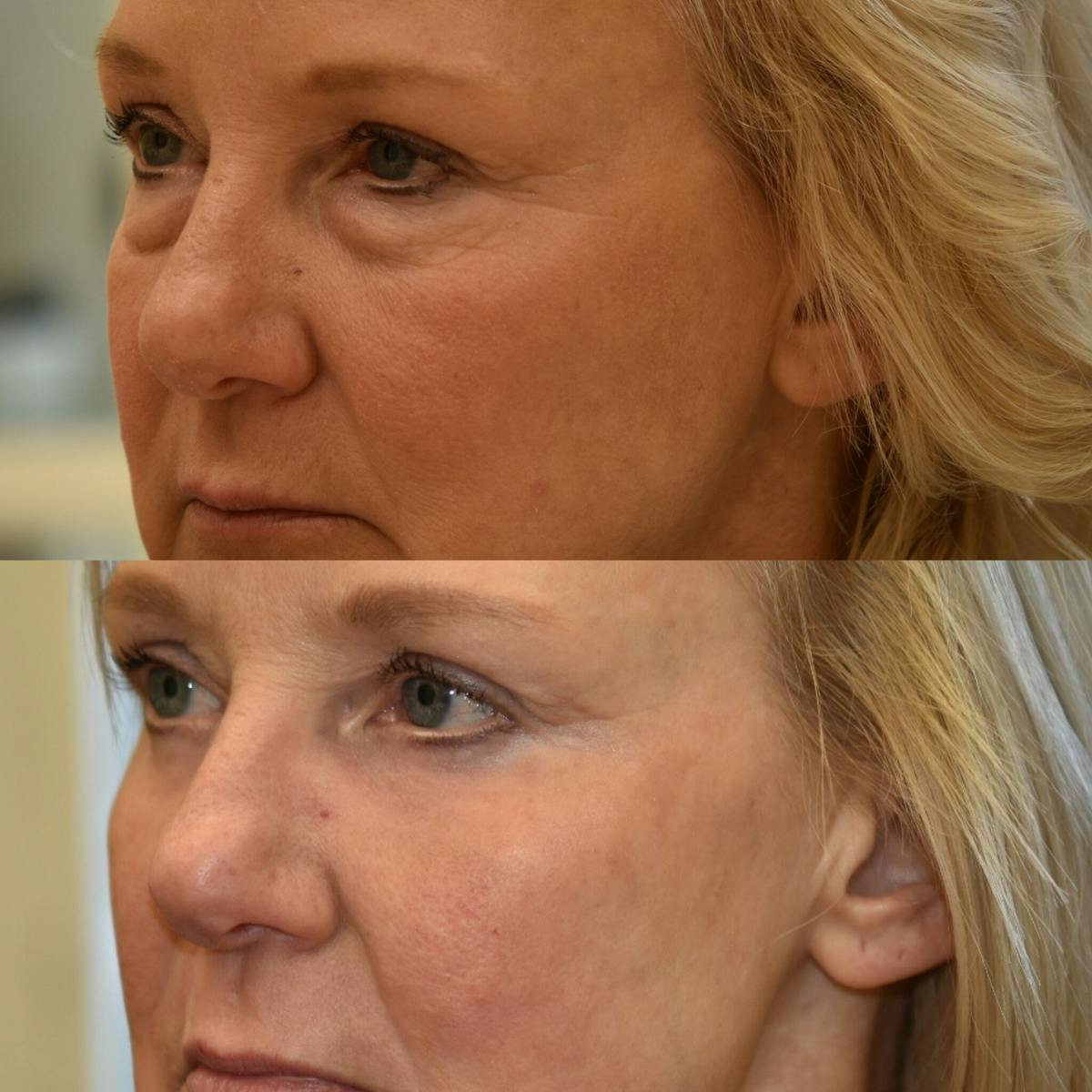 Eyelid Surgery Before & After Gallery - Patient 327140 - Image 3
