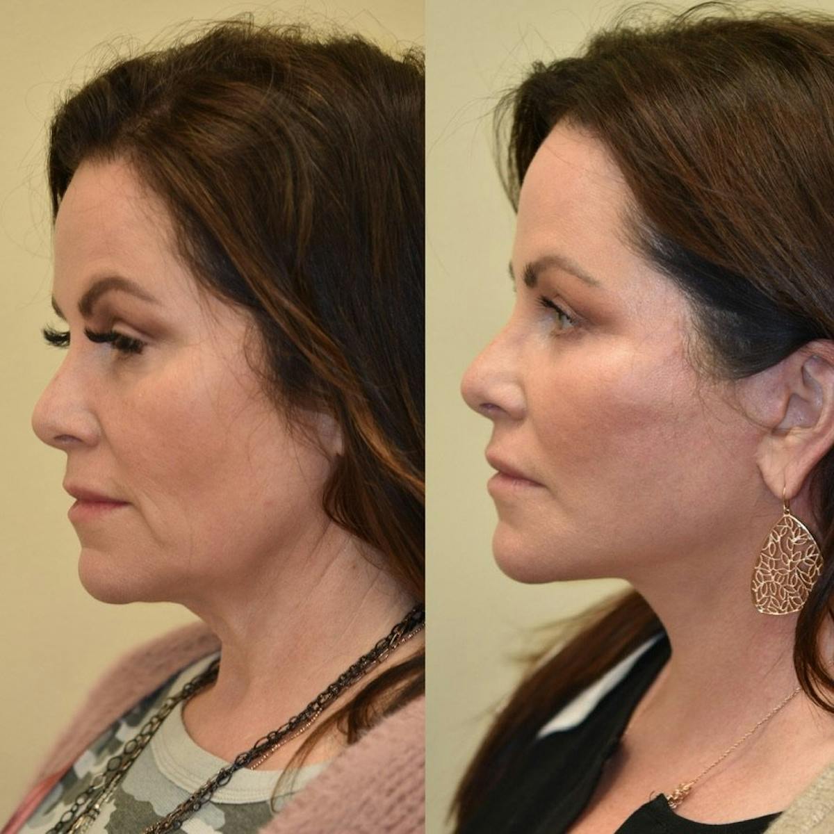 Neck Lift Before & After Gallery - Patient 322564 - Image 1