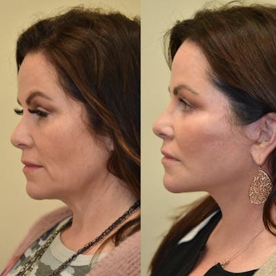 Neck Lift Before & After Gallery - Patient 322564 - Image 1