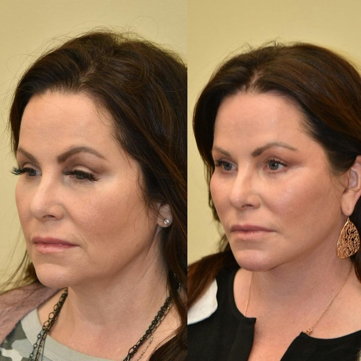 Neck Lift Before & After Gallery - Patient 322564 - Image 2