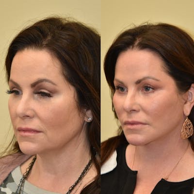 Neck Lift Before & After Gallery - Patient 322564 - Image 1