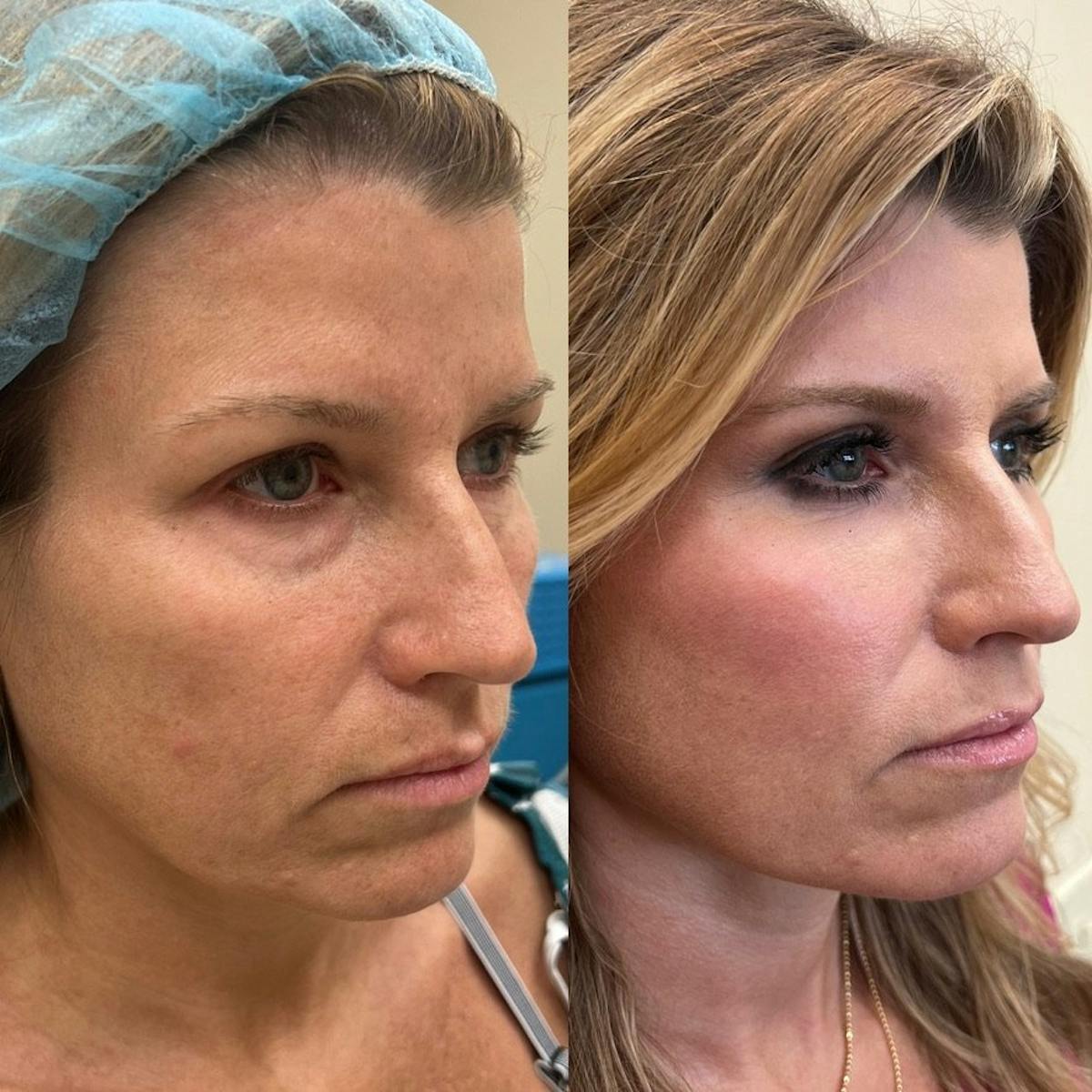 Fat Transfer Before & After Gallery - Patient 282899 - Image 1