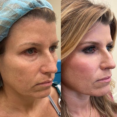 Fat Transfer Before & After Gallery - Patient 282899 - Image 1