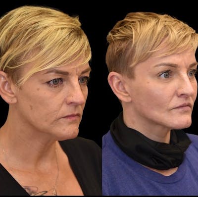 Facial Rejuvenation Before & After Gallery - Patient 255194 - Image 1