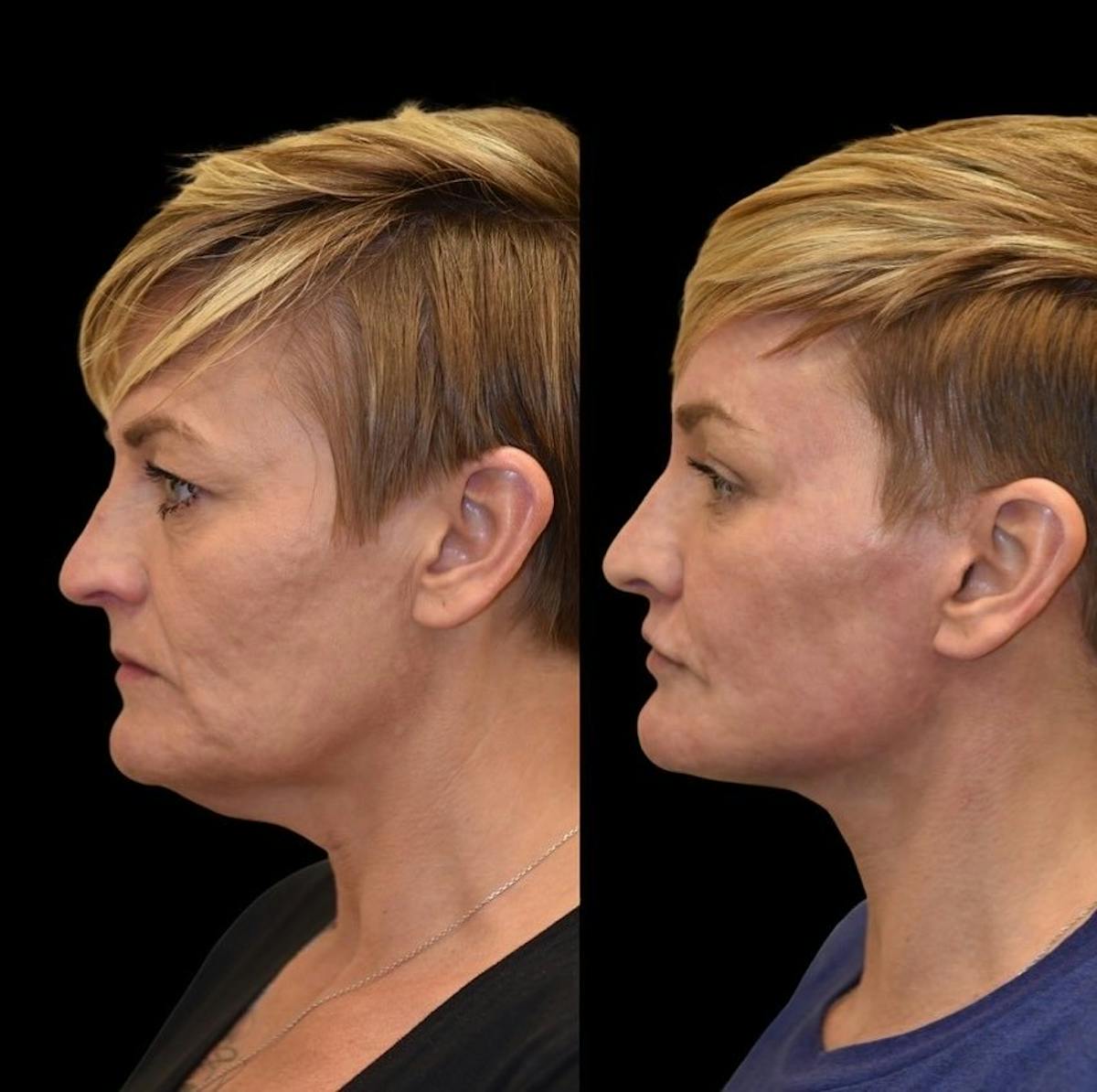 Facial Rejuvenation Before & After Gallery - Patient 255194 - Image 2