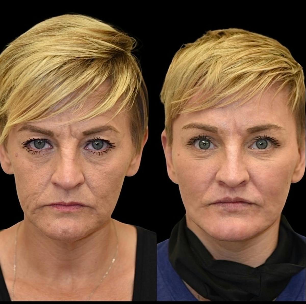 Facial Rejuvenation Before & After Gallery - Patient 255194 - Image 3