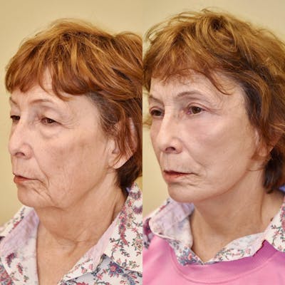 Neck Lift Before & After Gallery - Patient 614430 - Image 1