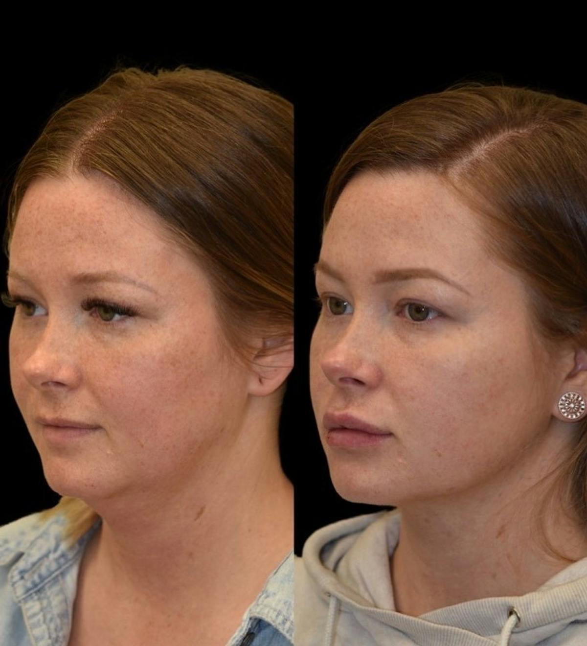 Neck Lift Before & After Gallery - Patient 304500 - Image 1