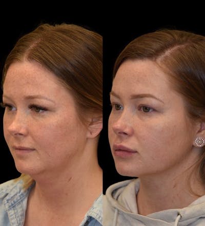 Neck Lift Before & After Gallery - Patient 304500 - Image 1