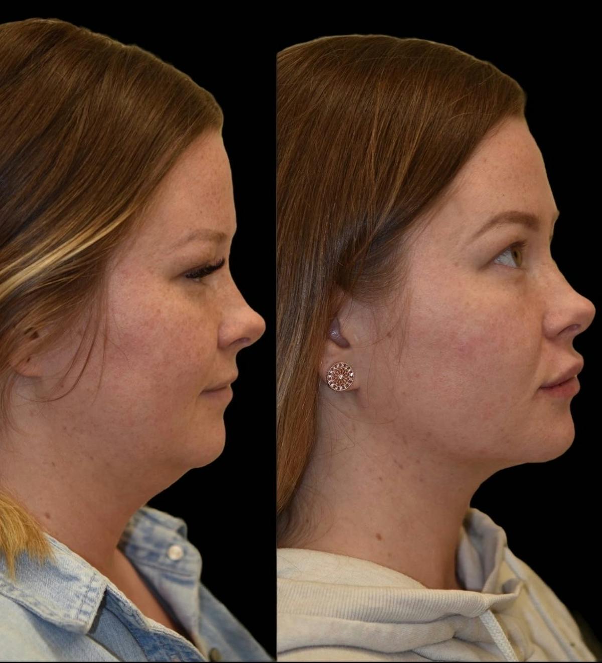 Neck Lift Before & After Gallery - Patient 304500 - Image 2
