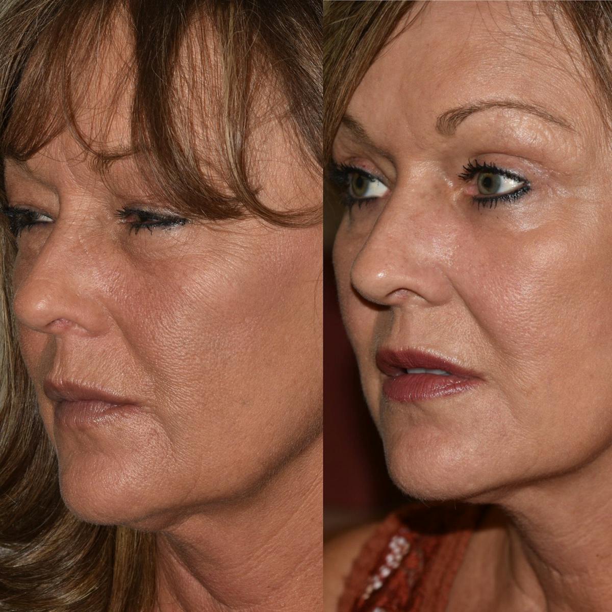 Brow Lift Before & After Gallery - Patient 713385 - Image 1