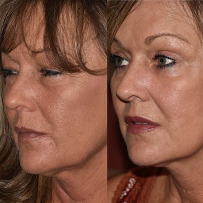 Brow Lift Before & After Gallery - Patient 713385 - Image 1